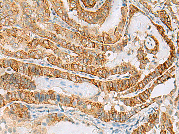 Immunohistochemistry of paraffin-embedded Human thyroid cancer tissue using TA370670 (FARP2 Antibody) at dilution 1/70 (Original magnification: x200)