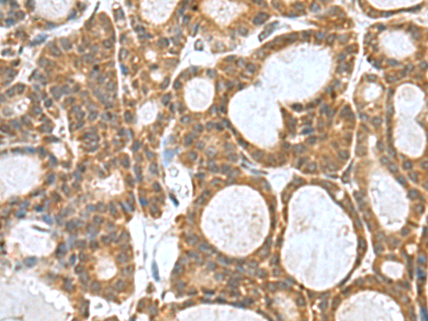 Immunohistochemistry of paraffin-embedded Human thyroid cancer tissue using TA370682 (KANSL1L Antibody) at dilution 1/80 (Original magnification: x200)