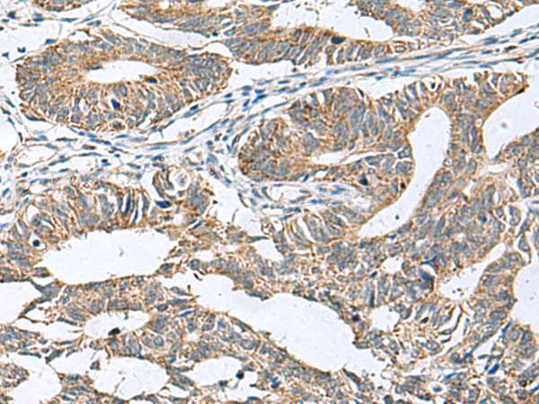 Immunohistochemistry of paraffin-embedded Human colorectal cancer tissue using TA370685 (DPY19L3 Antibody) at dilution 1/120 (Original magnification: x200)