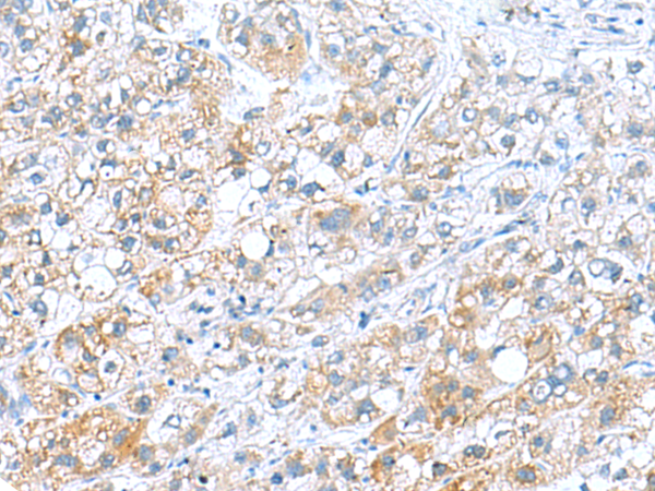 Immunohistochemistry of paraffin-embedded Human liver cancer tissue using TA370721 (DNAL1 Antibody) at dilution 1/70 (Original magnification: x200)
