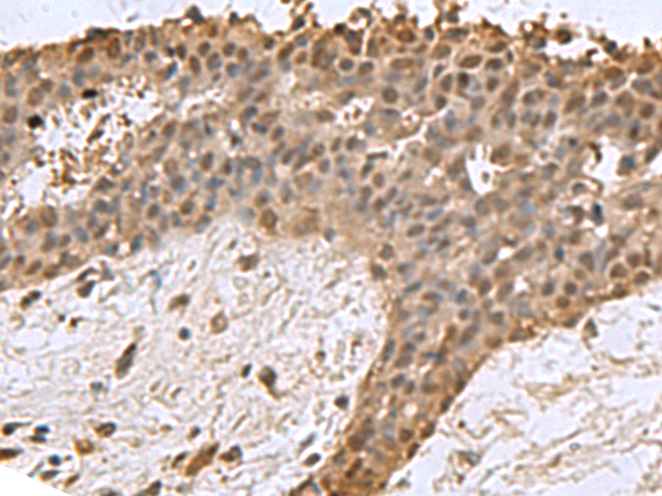 Immunohistochemistry of paraffin-embedded Human breast cancer tissue using TA370729 (DCTPP1 Antibody) at dilution 1/85 (Original magnification: x200)