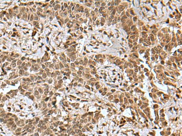 Immunohistochemistry of paraffin-embedded Human ovarian cancer tissue using TA370760 (BCL7B Antibody) at dilution 1/85 (Original magnification: x200)