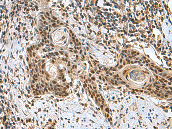 Immunohistochemistry of paraffin-embedded Human esophagus cancer tissue using TA370773 (PRPF40A Antibody) at dilution 1/60 (Original magnification: x200)