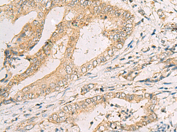 Immunohistochemistry of paraffin-embedded Human cervical cancer tissue using TA370820 (SPACA1 Antibody) at dilution 1/50 (Original magnification: x200)