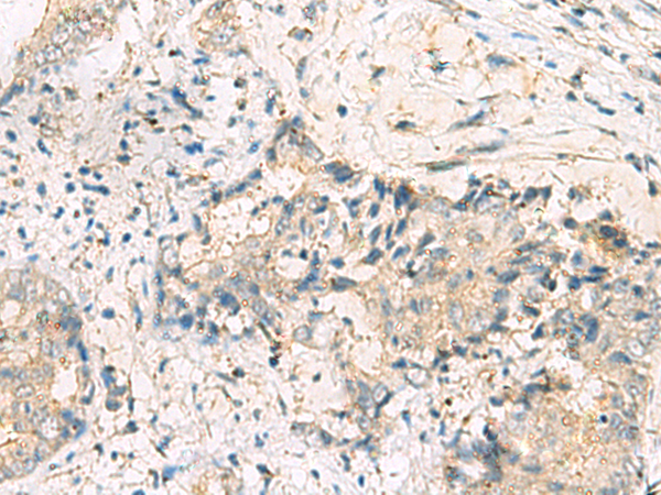 Immunohistochemistry of paraffin-embedded Human cervical cancer tissue using TA370821 (MGAT4B Antibody) at dilution 1/50 (Original magnification: x200)