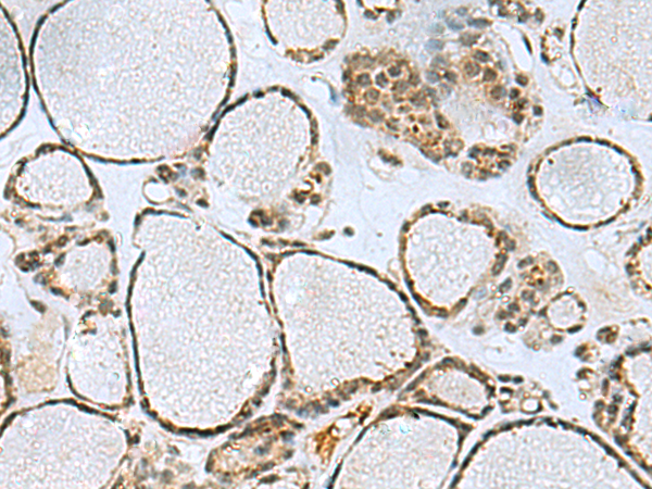 Immunohistochemistry of paraffin-embedded Human thyroid cancer tissue using TA370840 (PTPA Antibody) at dilution 1/50 (Original magnification: x200)