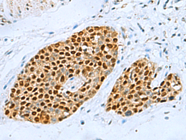 Immunohistochemistry of paraffin-embedded Human esophagus cancer tissue using TA370842 (TFAP4 Antibody) at dilution 1/70 (Original magnification: x200)