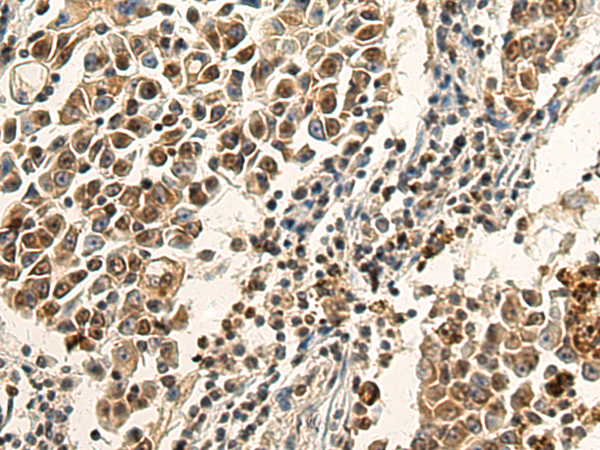 Immunohistochemistry of paraffin-embedded Human lung cancer tissue using TA370845 (CD2BP2 Antibody) at dilution 1/120 (Original magnification: x200)