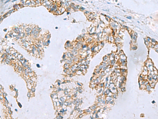 Immunohistochemistry of paraffin-embedded Human gastric cancer tissue using TA370849 (MGME1 Antibody) at dilution 1/70 (Original magnification: x200)