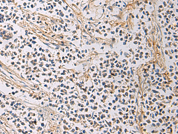 Immunohistochemistry of paraffin-embedded Human breast cancer tissue using TA370854 (GMPR Antibody) at dilution 1/60 (Original magnification: x200)