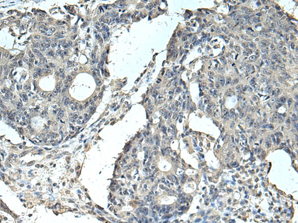 Immunohistochemistry of paraffin-embedded Human colorectal cancer tissue using TA370875 (SLC35F6 Antibody) at dilution 1/95 (Original magnification: x200)
