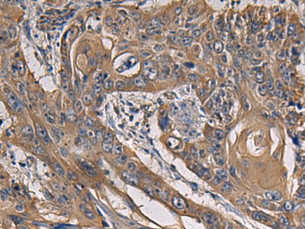 Immunohistochemistry of paraffin-embedded Human esophagus cancer tissue using TA370879 (CCNI Antibody) at dilution 1/65 (Original magnification: x200)
