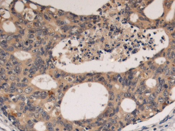 Immunohistochemistry of paraffin-embedded Human colorectal cancer tissue using TA370924 (EML1 Antibody) at dilution 1/130 (Original magnification: x200)