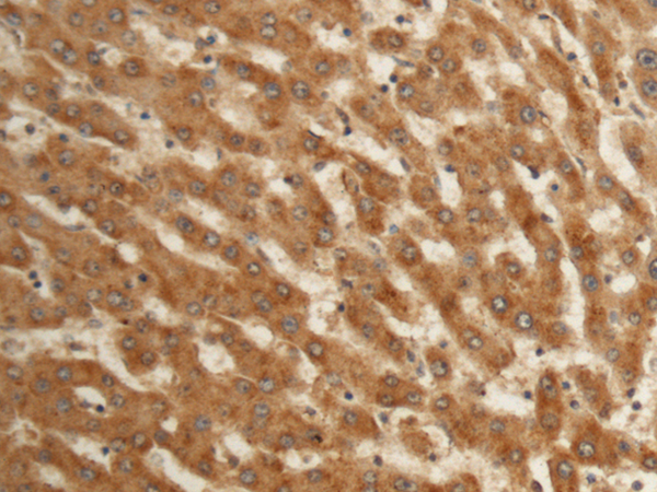 Immunohistochemistry of paraffin-embedded Human liver cancer tissue using TA370925 (EFHC2 Antibody) at dilution 1/150 (Original magnification: x200)