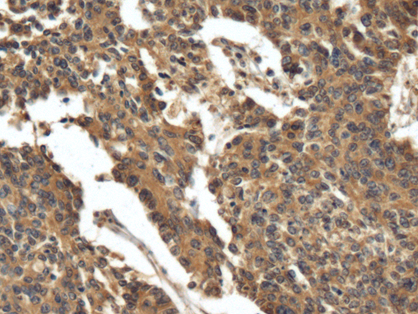 Immunohistochemistry of paraffin-embedded Human colorectal cancer tissue using TA370934 (FIBIN Antibody) at dilution 1/120 (Original magnification: x200)