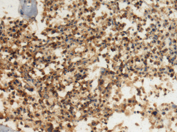 Immunohistochemistry of paraffin-embedded Human ovarian cancer tissue using TA370940 (DHX8 Antibody) at dilution 1/100 (Original magnification: x200)