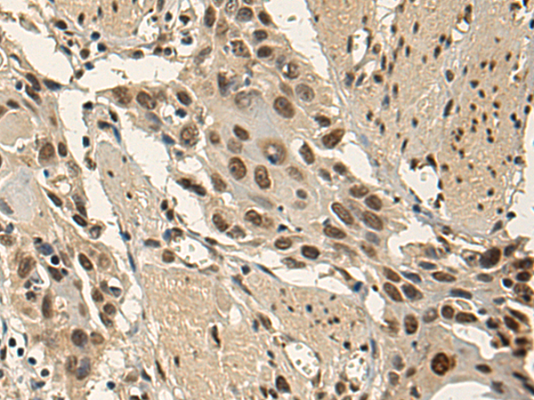 Immunohistochemistry of paraffin-embedded Human esophagus cancer tissue using TA370980 (EBF3 Antibody) at dilution 1/140 (Original magnification: x200)