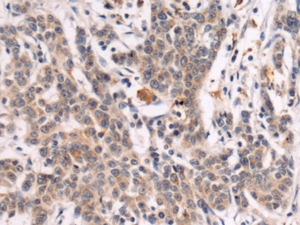Immunohistochemistry of paraffin-embedded Human colorectal cancer tissue using TA370981 (GALNT3 Antibody) at dilution 1/85 (Original magnification: x200)