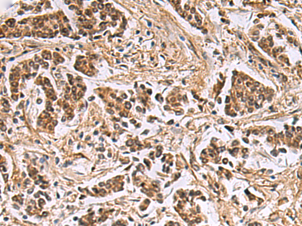 Immunohistochemistry of paraffin-embedded Human breast cancer tissue using TA370983 (DNA2 Antibody) at dilution 1/40 (Original magnification: x200)