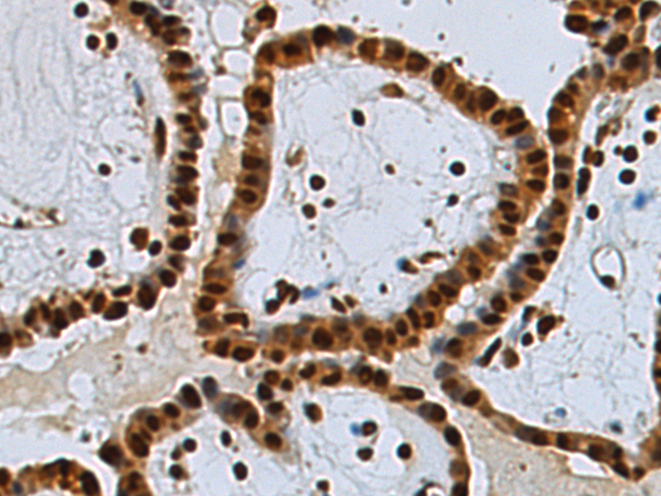 Immunohistochemistry of paraffin-embedded Human thyroid cancer tissue using TA371000 (UBE2O Antibody) at dilution 1/120 (Original magnification: x200)