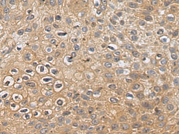 Immunohistochemistry of paraffin-embedded Human esophagus cancer tissue using TA371005 (CORO2B Antibody) at dilution 1/140 (Original magnification: x200)