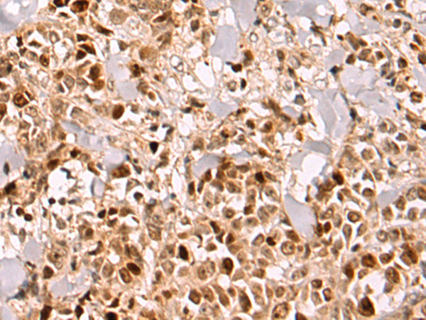 Immunohistochemistry of paraffin-embedded Human breast cancer tissue using TA371008 (ZNF639 Antibody) at dilution 1/100 (Original magnification: x200)