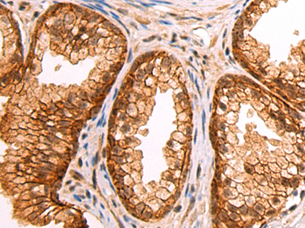 Immunohistochemistry of paraffin-embedded Human prostate cancer tissue using TA371011 (PCYOX1 Antibody) at dilution 1/130 (Original magnification: x200)