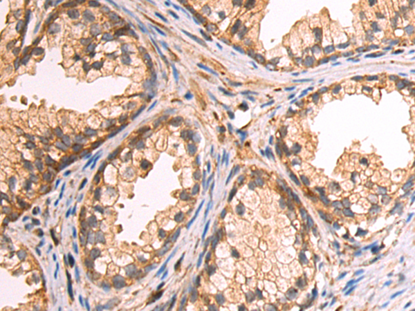 Immunohistochemistry of paraffin-embedded Human prostate cancer tissue using TA371012 (OSGIN2 Antibody) at dilution 1/70 (Original magnification: x200)
