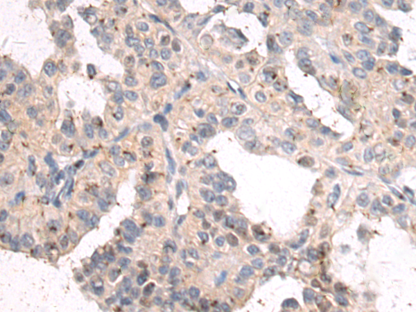 Immunohistochemistry of paraffin-embedded Human thyroid cancer tissue using TA371064 (MOCOS Antibody) at dilution 1/50 (Original magnification: x200)