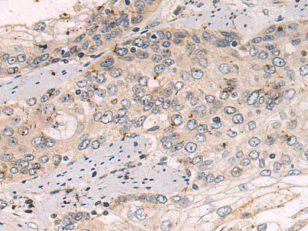 Immunohistochemistry of paraffin-embedded Human esophagus cancer tissue using TA371068 (COPB2 Antibody) at dilution 1/50 (Original magnification: x200)