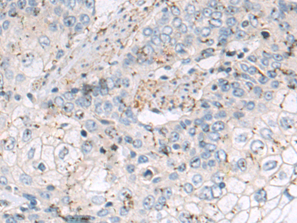 Immunohistochemistry of paraffin-embedded Human esophagus cancer tissue using TA371070 (PPFIA1 Antibody) at dilution 1/100 (Original magnification: x200)
