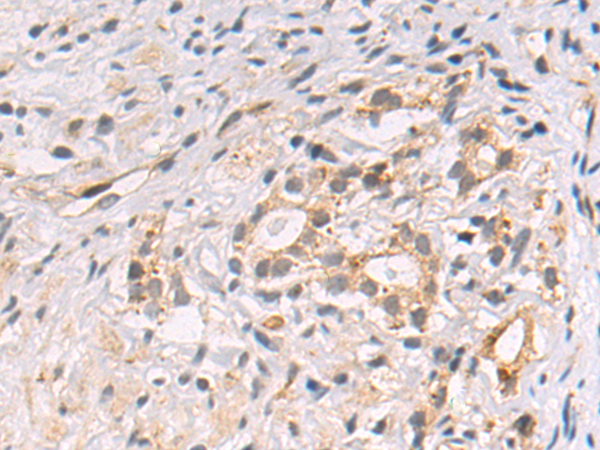 Immunohistochemistry of paraffin-embedded Human prostate cancer tissue using TA371085 (SIMC1 Antibody) at dilution 1/50 (Original magnification: x200)