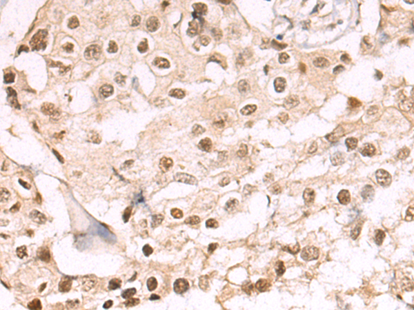 Immunohistochemistry of paraffin-embedded Human breast cancer tissue using TA371087 (SS18L1 Antibody) at dilution 1/65 (Original magnification: x200)