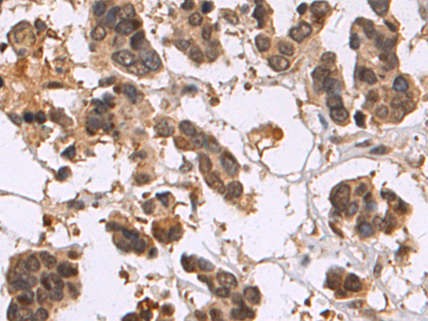 Immunohistochemistry of paraffin-embedded Human colorectal cancer tissue using TA371088 (PHIP Antibody) at dilution 1/50 (Original magnification: x200)