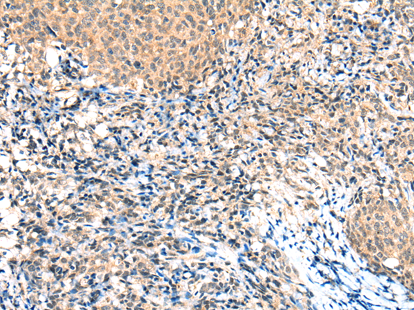 Immunohistochemistry of paraffin-embedded Human cervical cancer tissue using TA371185 (NCOR2 Antibody) at dilution 1/30 (Original magnification: x200)