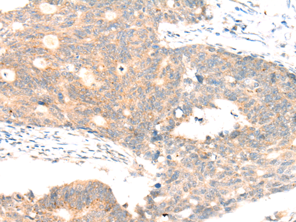 Immunohistochemistry of paraffin-embedded Human liver cancer tissue using TA371195 (ABCA10 Antibody) at dilution 1/20 (Original magnification: x200)