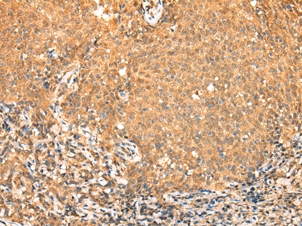Immunohistochemistry of paraffin-embedded Human cervical cancer tissue using TA371197 (TADA2A Antibody) at dilution 1/25 (Original magnification: x200)