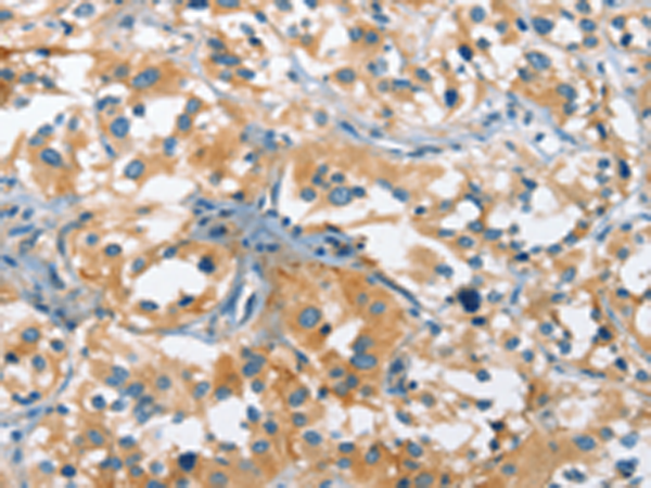 Immunohistochemistry of paraffin-embedded Human thyroid cancer tissue using TA371277 (CACNA1C Antibody) at dilution 1/20 (Original magnification: x200)