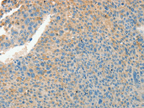 Immunohistochemistry of paraffin-embedded Human liver cancer tissue using TA371300 (CHRDL2 Antibody) at dilution 1/20 (Original magnification: x200)