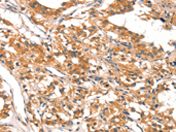 Immunohistochemistry of paraffin-embedded Human thyroid cancer tissue using TA371312 (DAB2IP Antibody) at dilution 1/20 (Original magnification: x200)