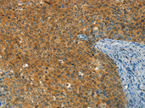 Immunohistochemistry of paraffin-embedded Human cervical cancer tissue using TA371322 (DIRAS1 Antibody) at dilution 1/30 (Original magnification: x200)