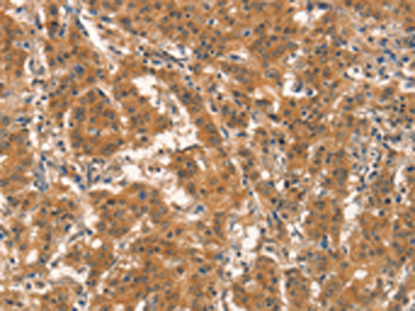 Immunohistochemistry of paraffin-embedded Human gasrtic cancer tissue using TA371330 (EID3 Antibody) at dilution 1/15 (Original magnification: x200)
