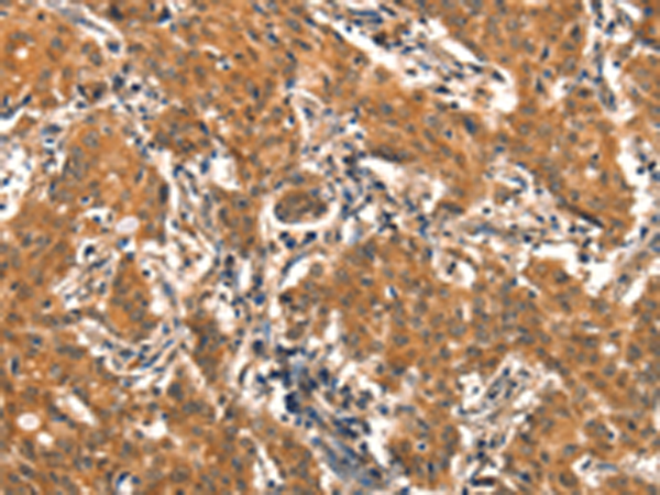 Immunohistochemistry of paraffin-embedded Human gasrtic cancer tissue using TA371334 (EPPIN Antibody) at dilution 1/25 (Original magnification: x200)