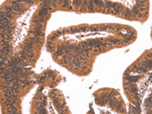 Immunohistochemistry of paraffin-embedded Human colon cancer tissue using TA371341 (FAIM Antibody) at dilution 1/25 (Original magnification: x200)