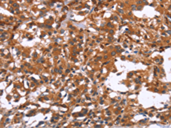 Immunohistochemistry of paraffin-embedded Human thyroid cancer tissue using TA371357 (GPHN Antibody) at dilution 1/15 (Original magnification: x200)