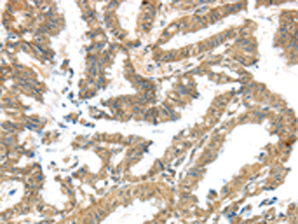Immunohistochemistry of paraffin-embedded Human colon cancer tissue using TA371395 (KCNG3 Antibody) at dilution 1/40 (Original magnification: x200)