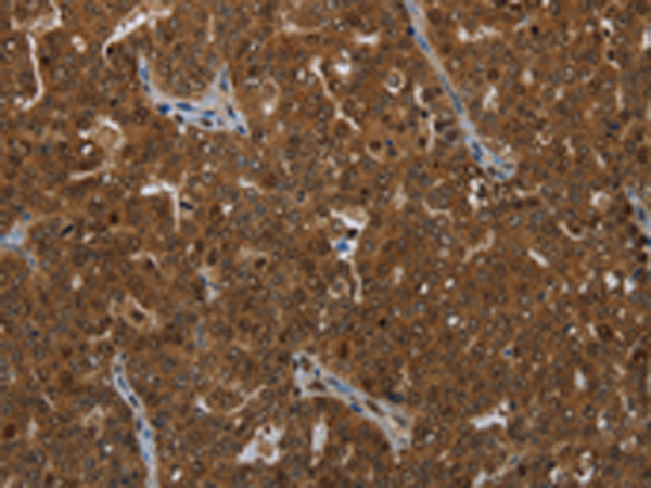 Immunohistochemistry of paraffin-embedded Human ovarian cancer tissue using TA371403 (KLRF1 Antibody) at dilution 1/25 (Original magnification: x200)