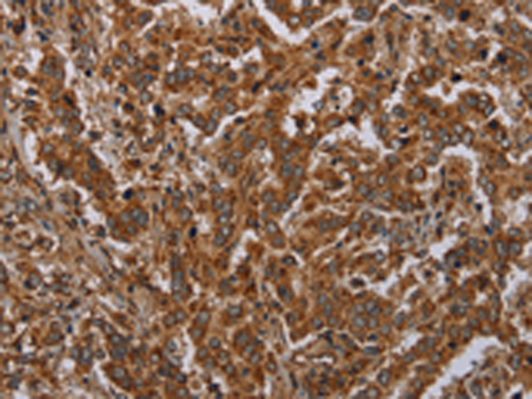 Immunohistochemistry of paraffin-embedded Human liver cancer tissue using TA371425 (ATP2A1 Antibody) at dilution 1/30 (Original magnification: x200)