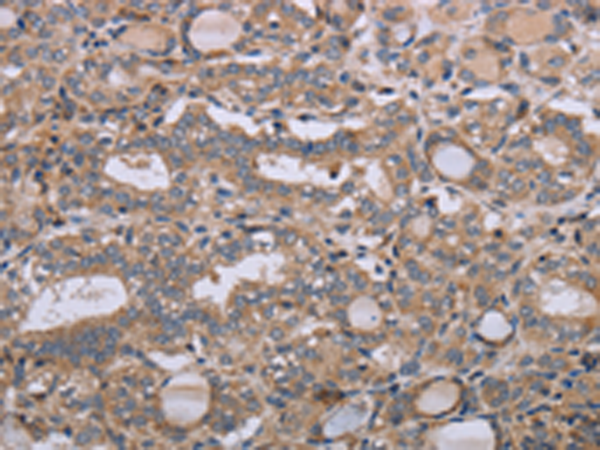Immunohistochemistry of paraffin-embedded Human thyroid cancer tissue using TA371438 (NAA25 Antibody) at dilution 1/40 (Original magnification: x200)