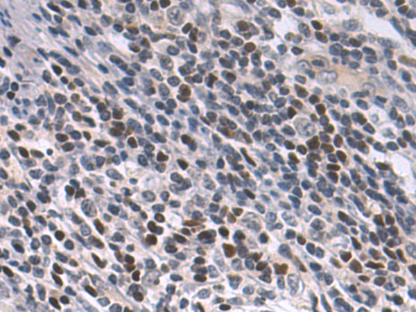 Immunohistochemistry of paraffin-embedded Human cervical cancer tissue using TA371464 (PPARGC1A Antibody) at dilution 1/50 (Original magnification: x200)